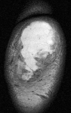 Figure 5 for case olecranon bursitis ( RID2082 )